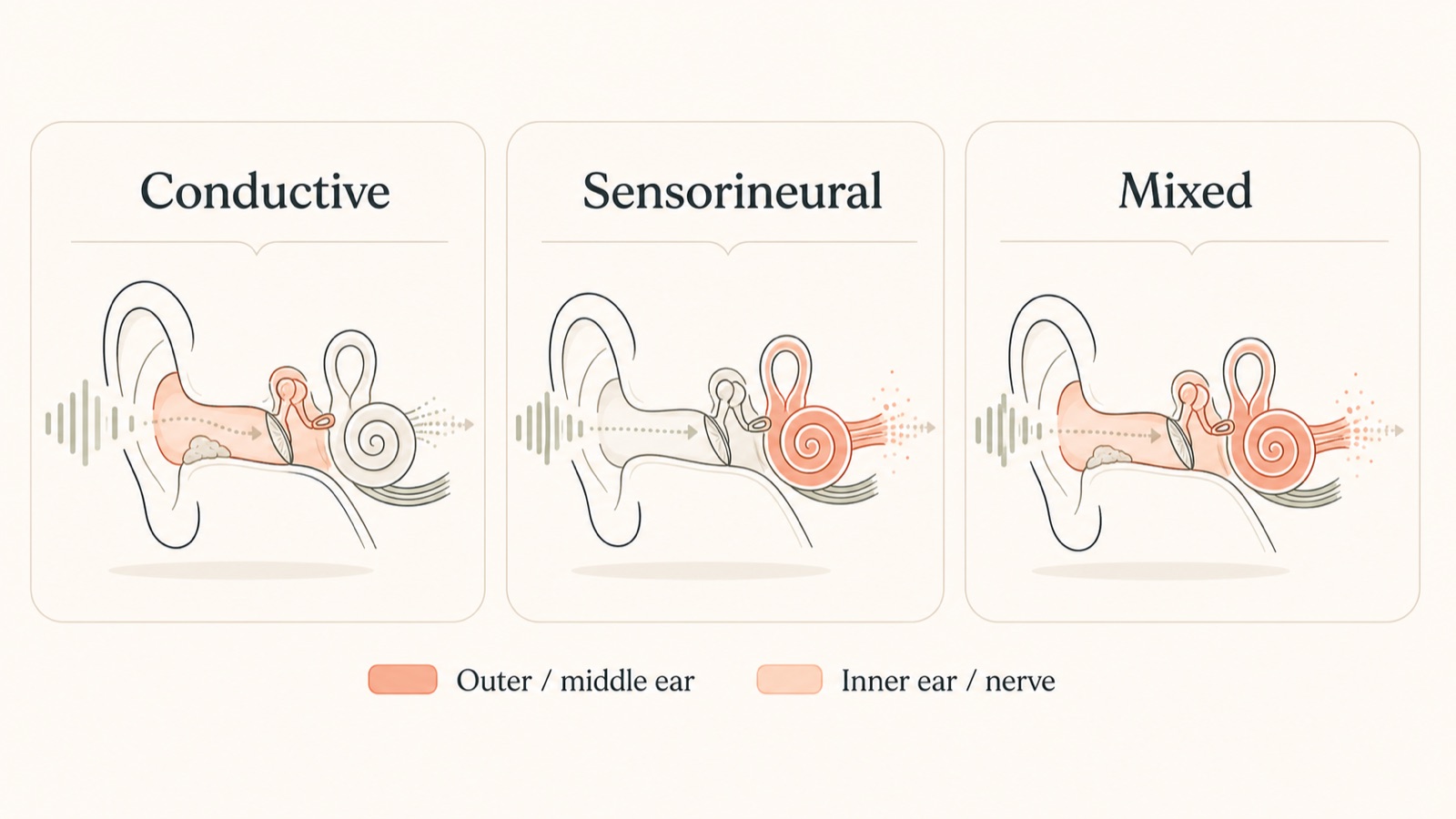 Diagram showing conductive, sensorineural and mixed hearing loss