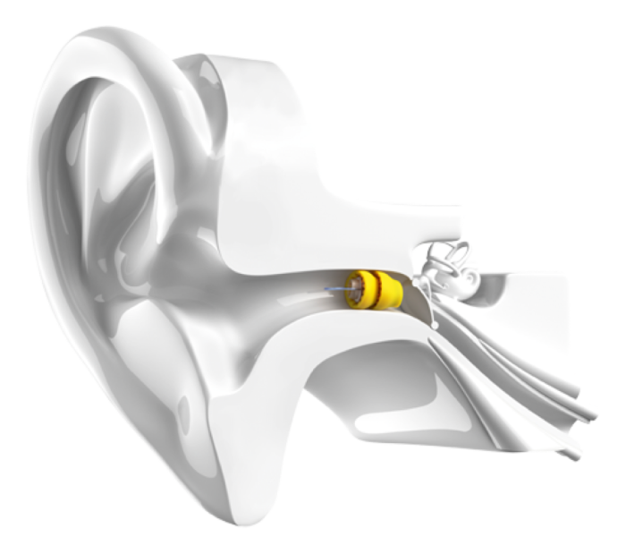 Phonak lyric